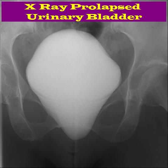 Bladder Prolapse Cystometrogram Serag Youssif Bladder Prolapse Cystometrogram Serag Youssif